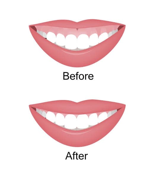 Gummy Smile treatment at Dr Alexa, Mayfair London