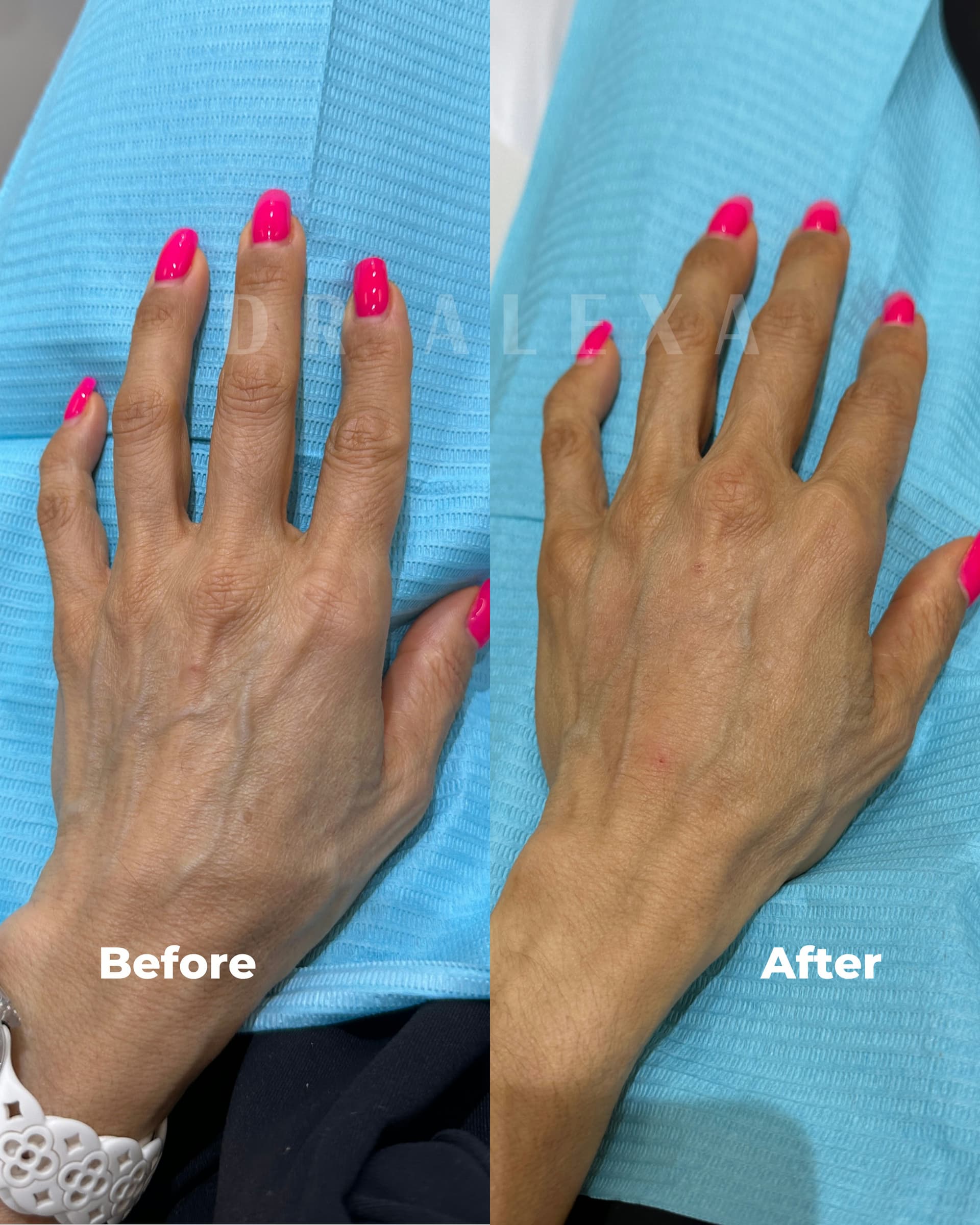 Hand Filler with Radiesse before and after — case 1, Dr Alexa Mayfair