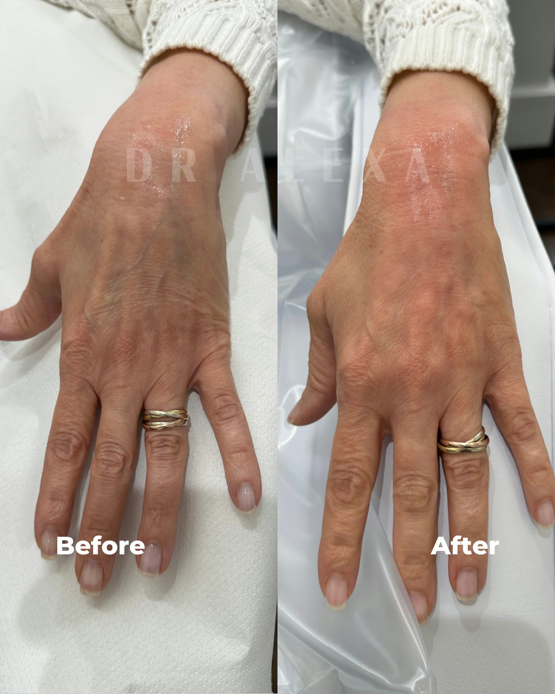 Hand Filler with Radiesse before and after — case 2, Dr Alexa Mayfair