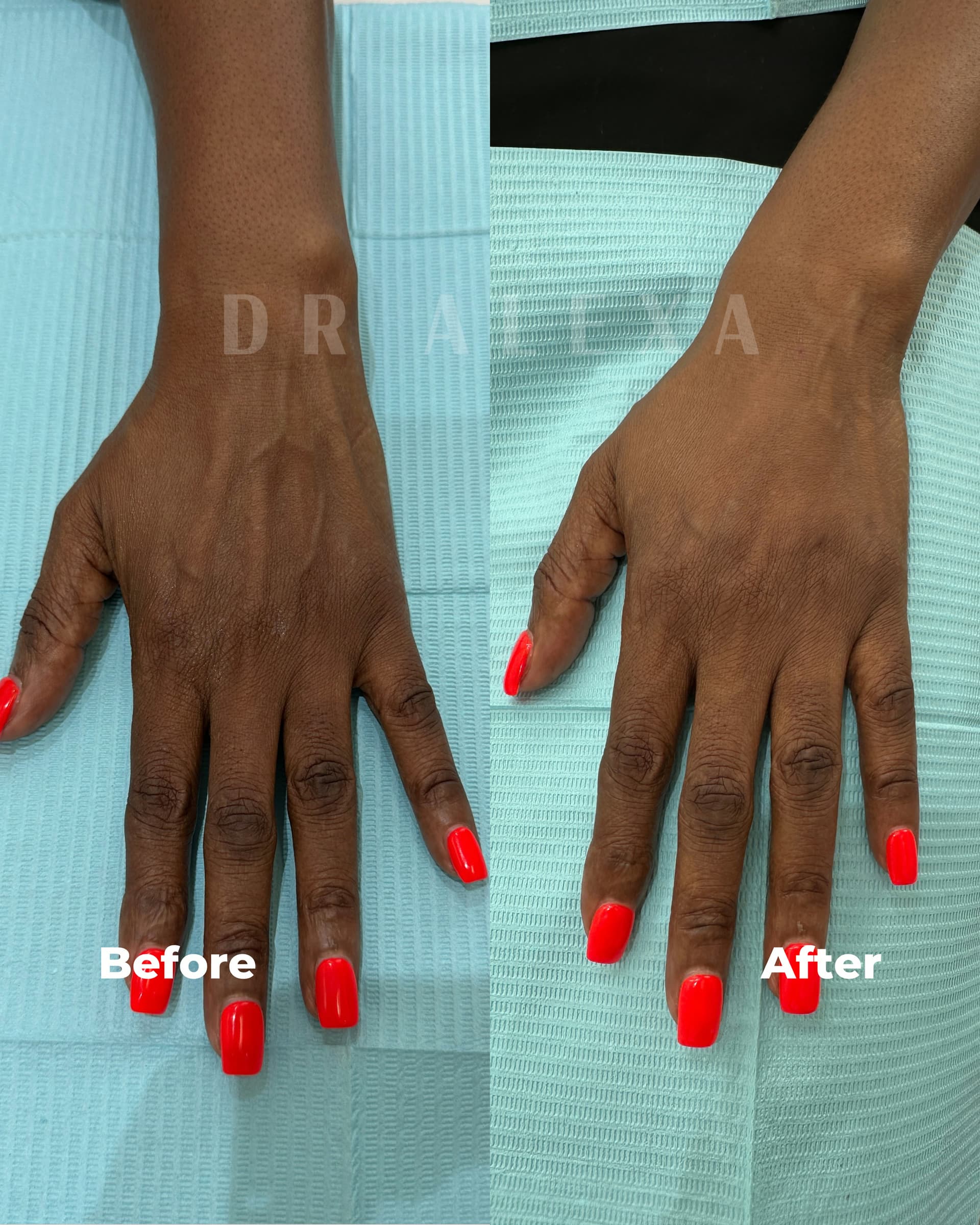 Hand Filler with Radiesse before and after — case 3, Dr Alexa Mayfair