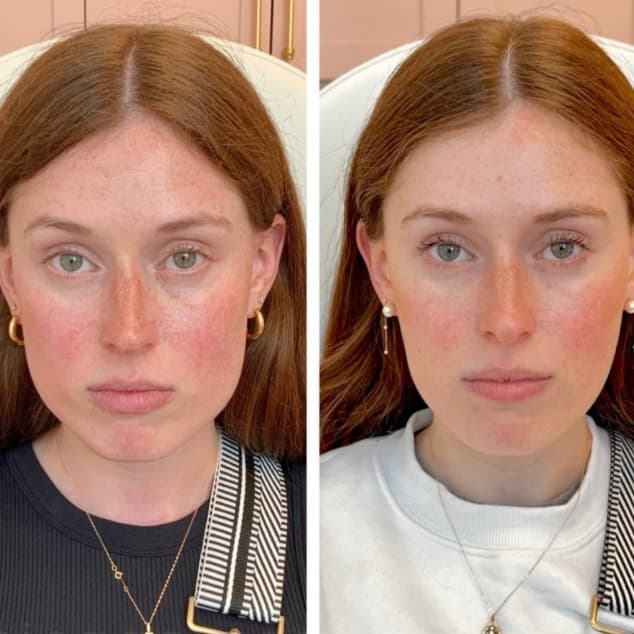 Jaw Slimming before and after — case 1, Dr Alexa Mayfair