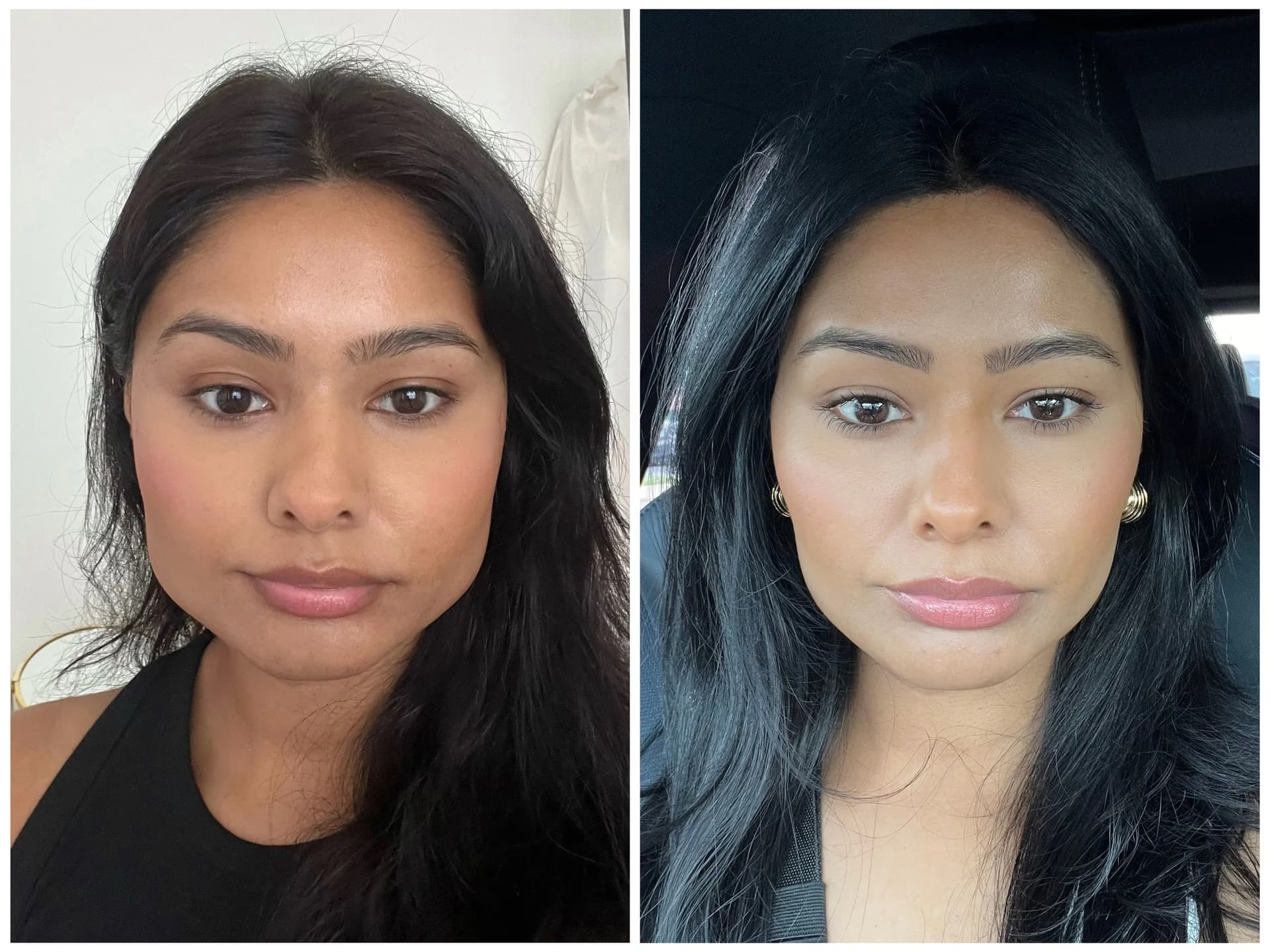 Jaw Slimming before and after — case 2, Dr Alexa Mayfair
