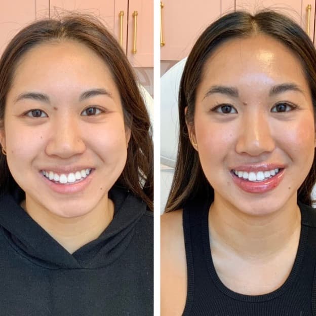Jaw Slimming before and after — case 3, Dr Alexa Mayfair