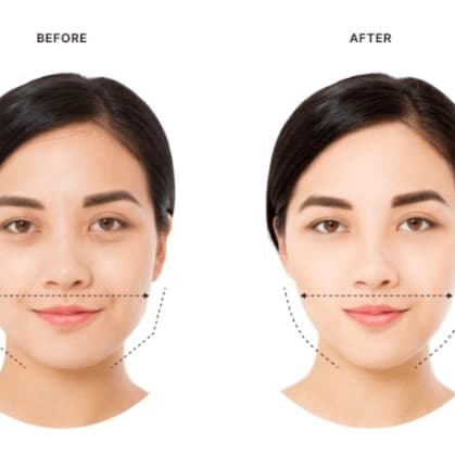 Jaw Slimming treatment at Dr Alexa, Mayfair London