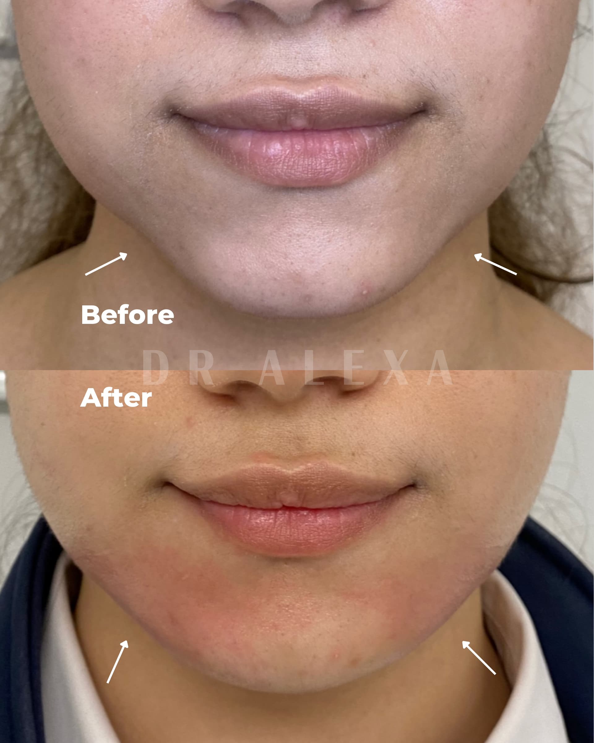 Jawline Filler before and after — case 1, Dr Alexa Mayfair