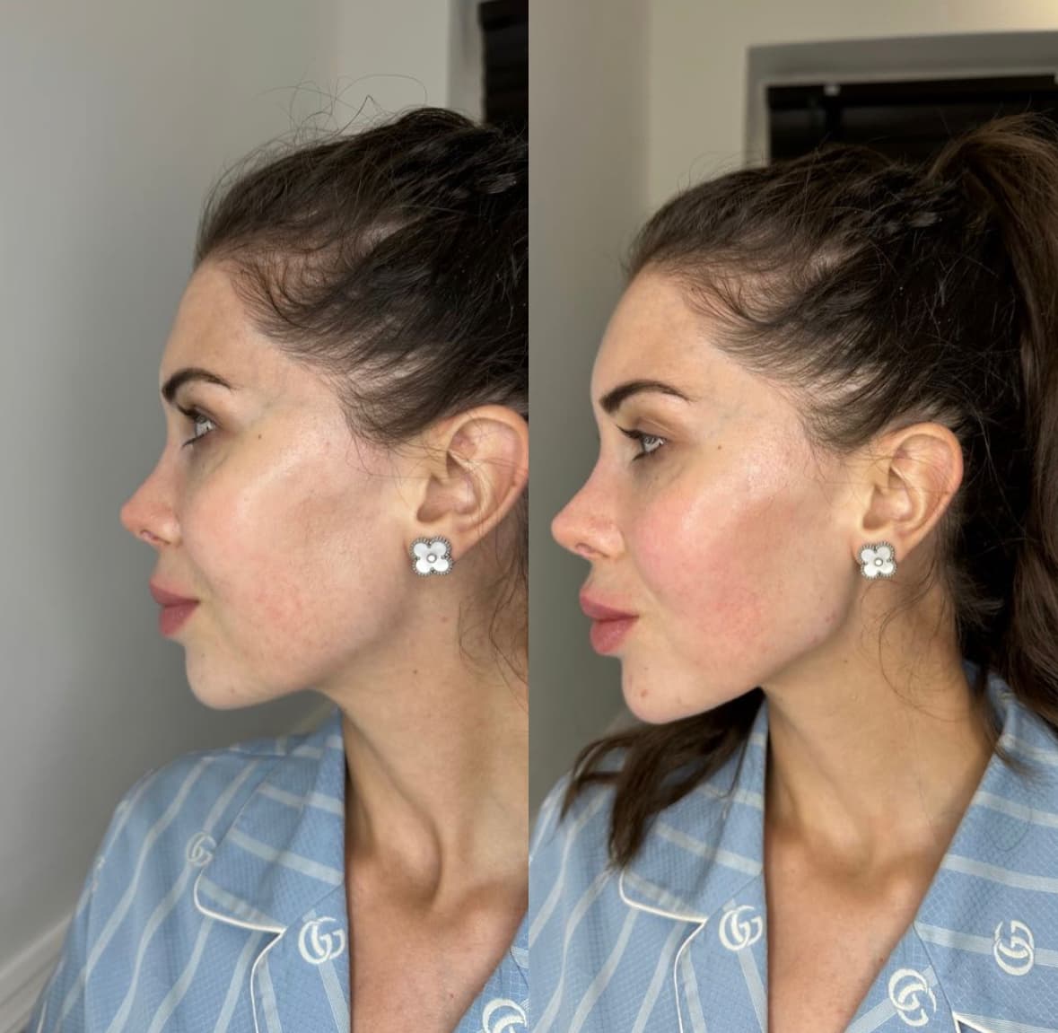 Jawline Filler before and after — case 2, Dr Alexa Mayfair