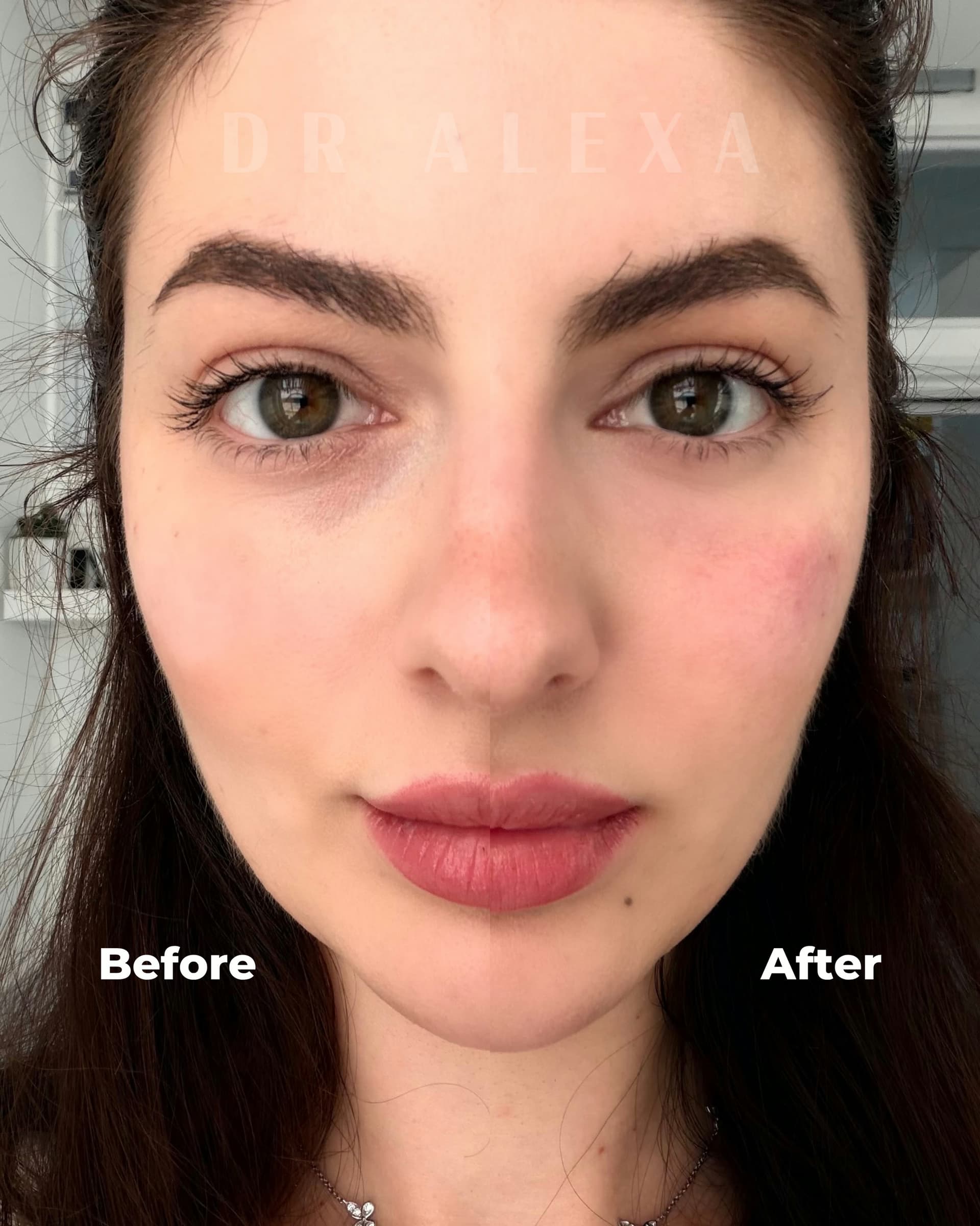 Juvelook before and after — case 1, Dr Alexa Mayfair