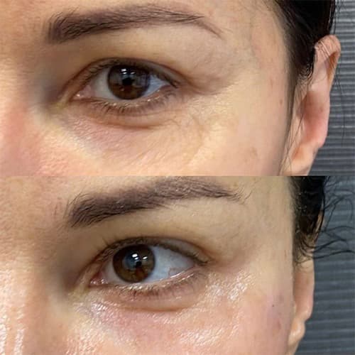 Juvelook before and after — case 2, Dr Alexa Mayfair