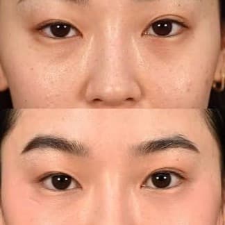 Juvelook before and after — case 3, Dr Alexa Mayfair
