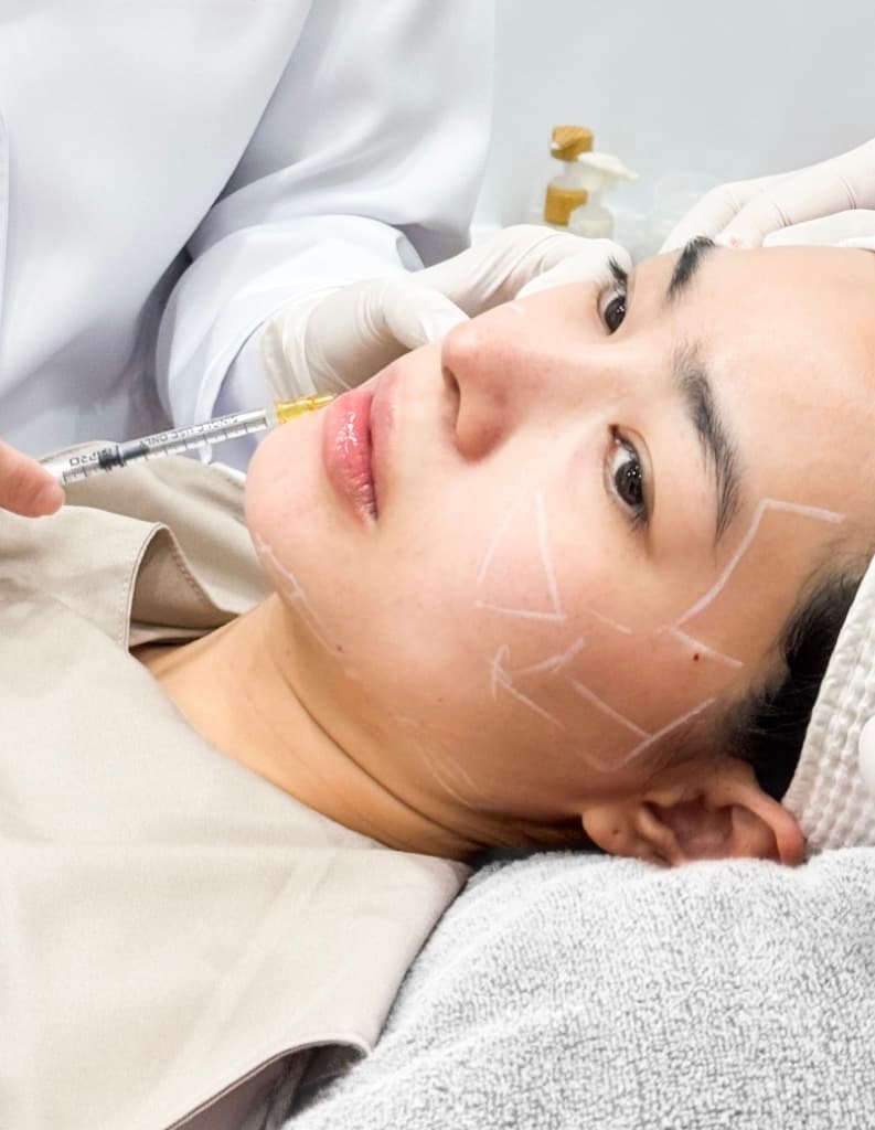 Juvelook treatment at Dr Alexa, Mayfair London