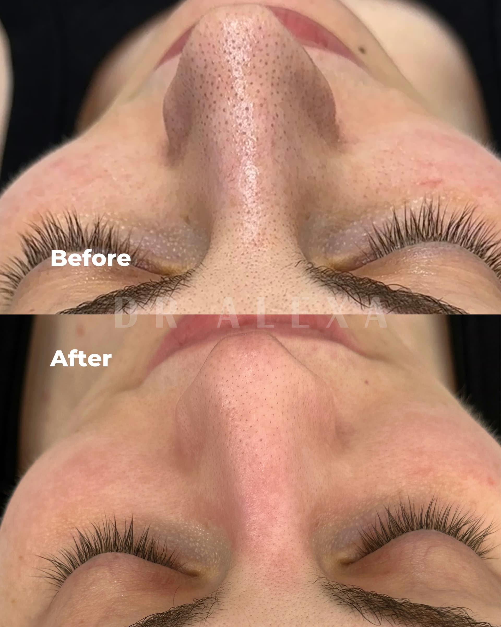 Microdermabrasion before and after — case 1, Dr Alexa Mayfair
