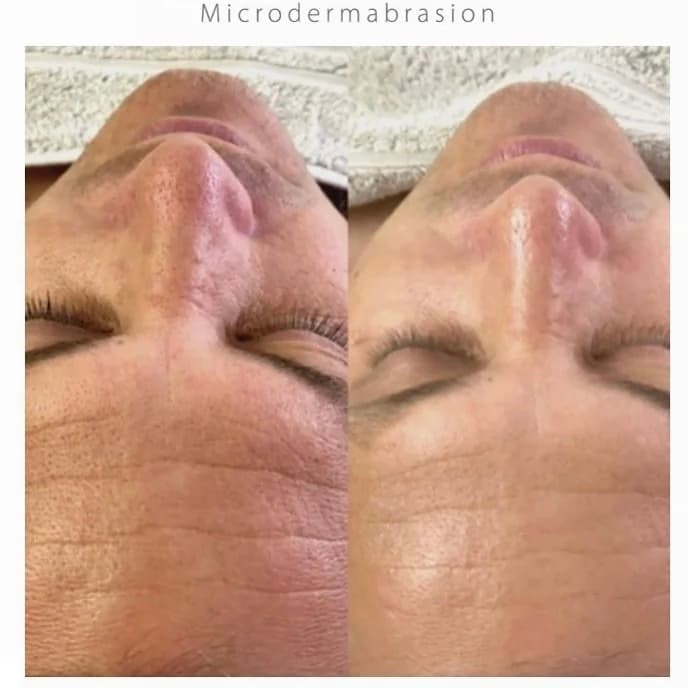 Microdermabrasion before and after — case 2, Dr Alexa Mayfair