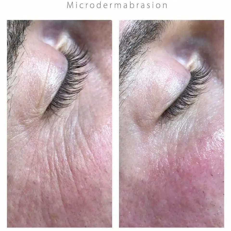 Microdermabrasion before and after — case 3, Dr Alexa Mayfair
