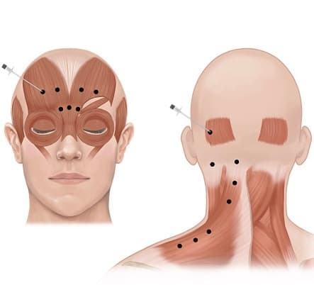 Migraines treatment at Dr Alexa, Mayfair London