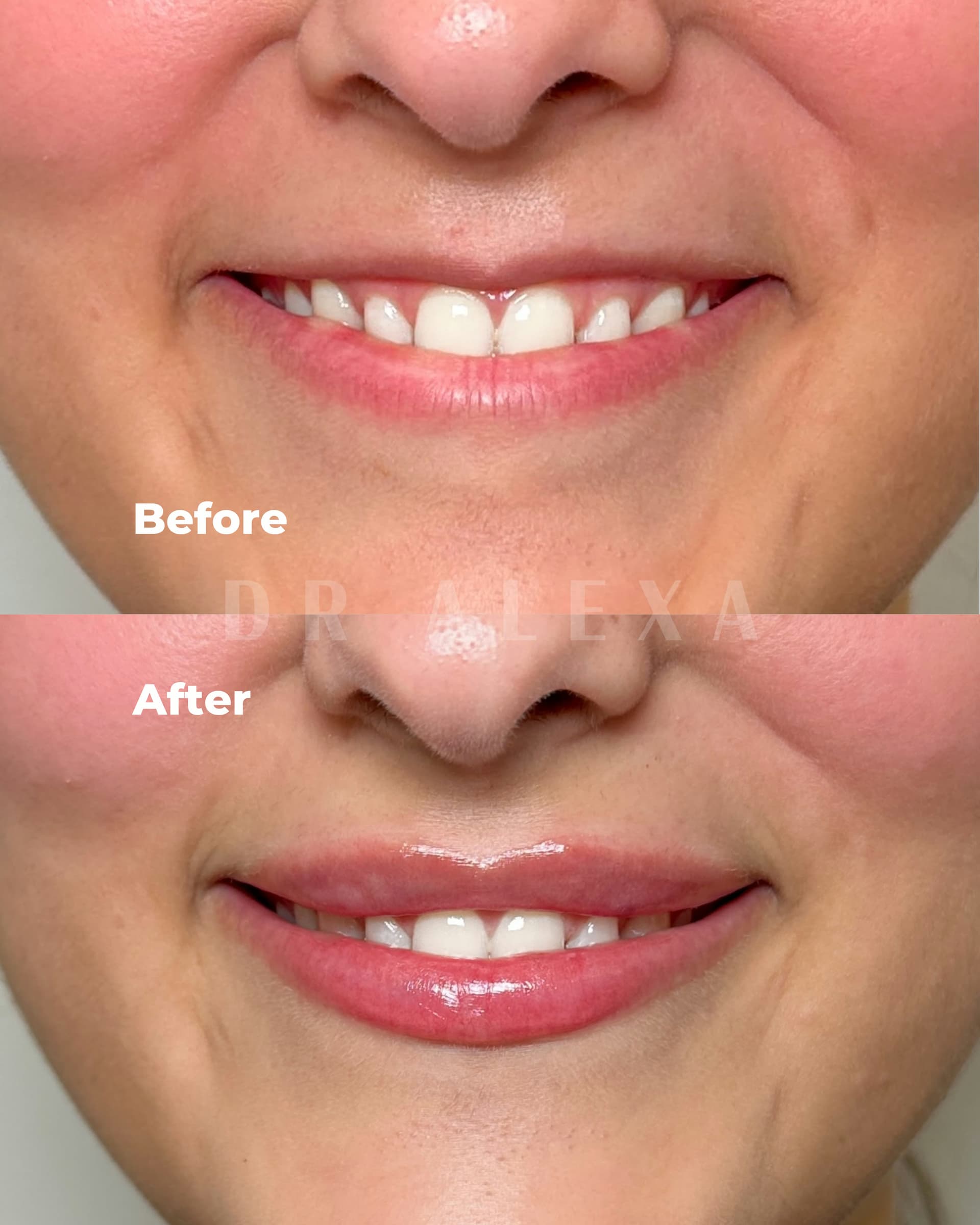 Lip Filler before and after — case 4, Dr Alexa Mayfair
