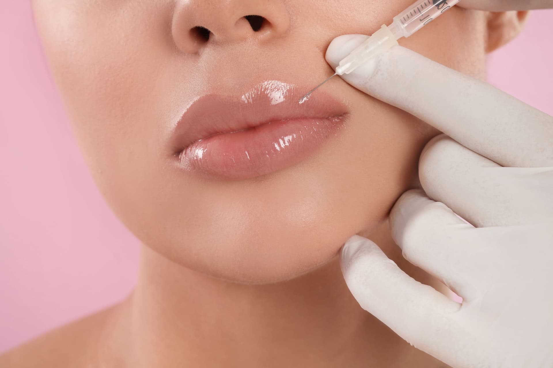 Lip Filler London Mayfair — doctor-led aesthetic treatment at Dr Alexa