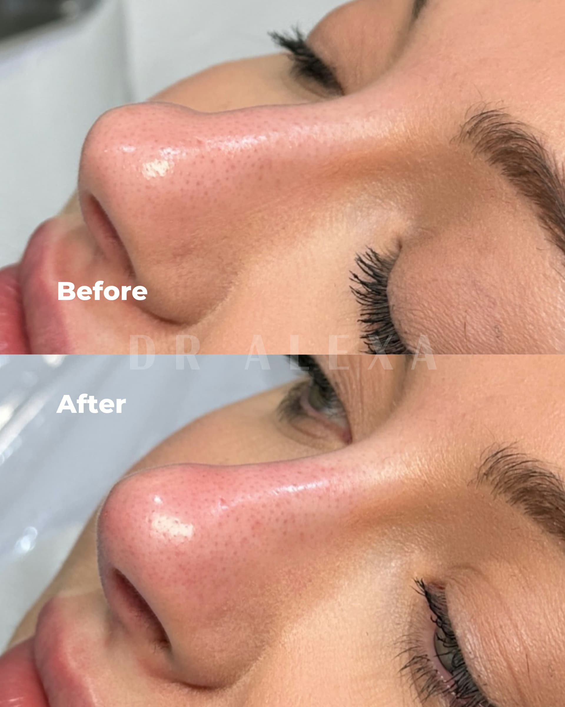 Nose Filler before and after — case 1, Dr Alexa Mayfair