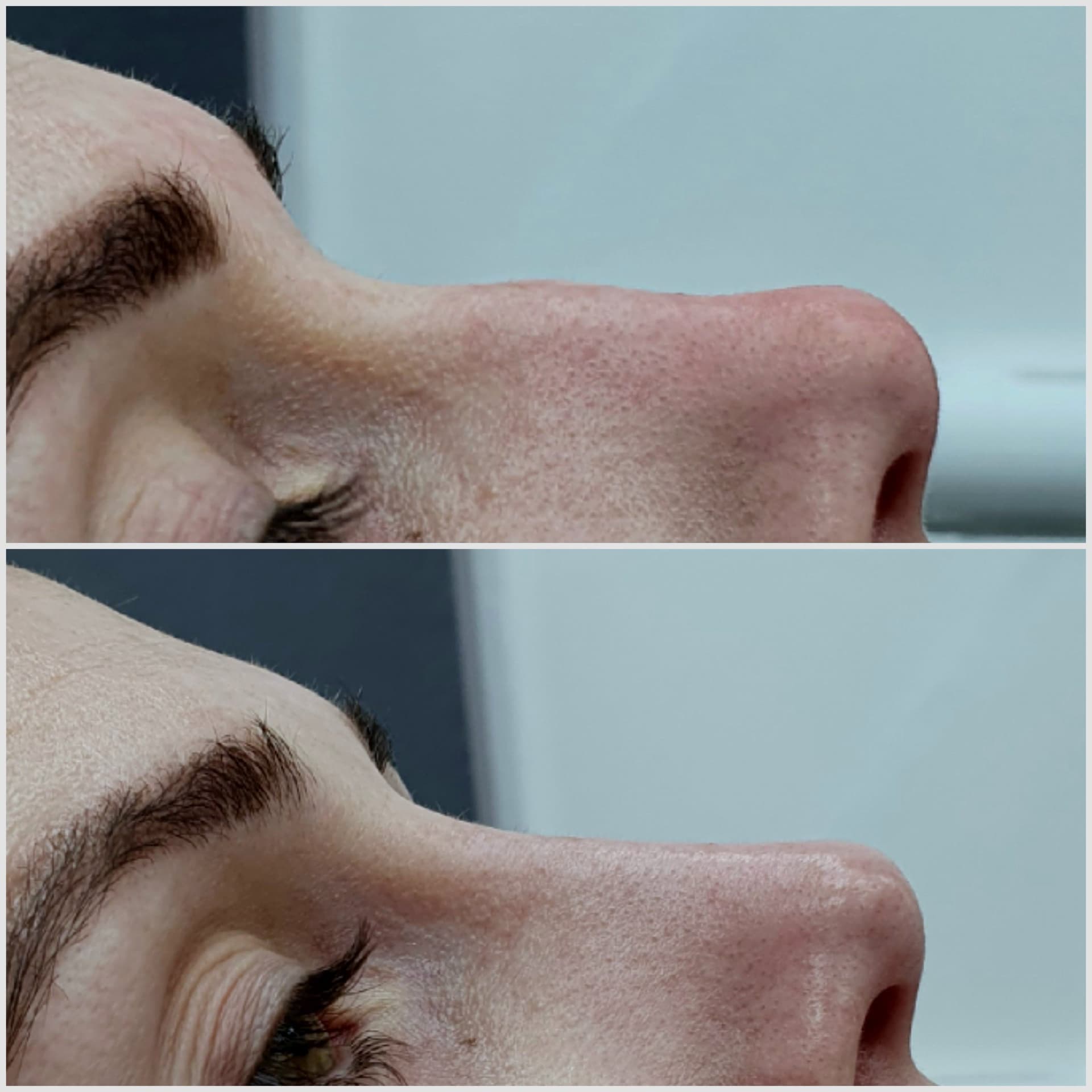 Nose Filler before and after — case 2, Dr Alexa Mayfair