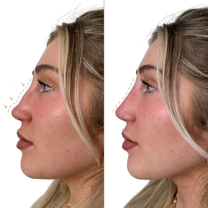 Nose Filler before and after — case 3, Dr Alexa Mayfair