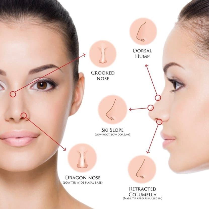 Nose Filler treatment at Dr Alexa, Mayfair London