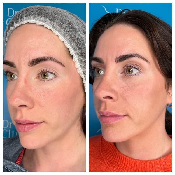 Profhilo and Profhilo Structura before and after — case 1, Dr Alexa Mayfair