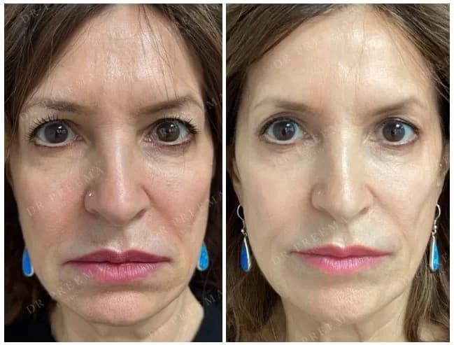 Profhilo and Profhilo Structura before and after — case 2, Dr Alexa Mayfair