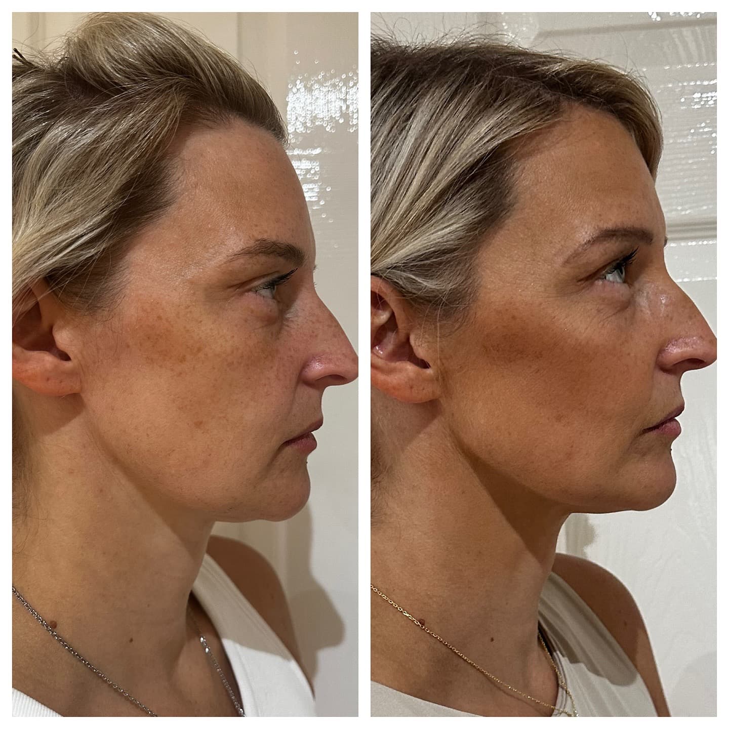 Profhilo and Profhilo Structura before and after — case 3, Dr Alexa Mayfair