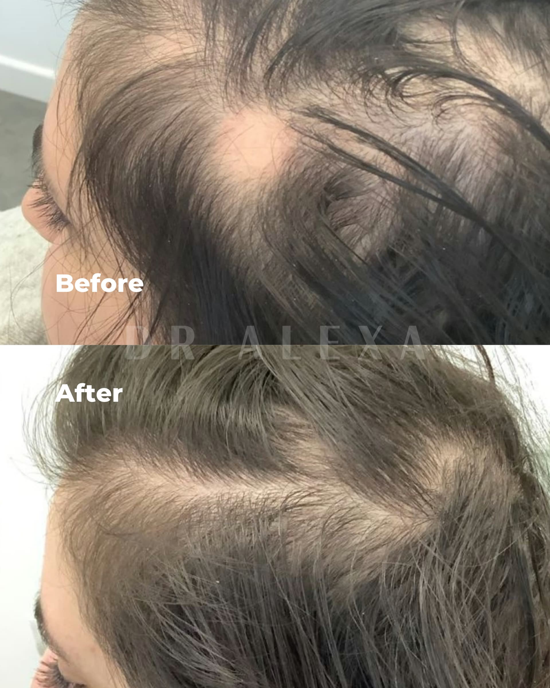 PRP / PRF before and after — case 1, Dr Alexa Mayfair