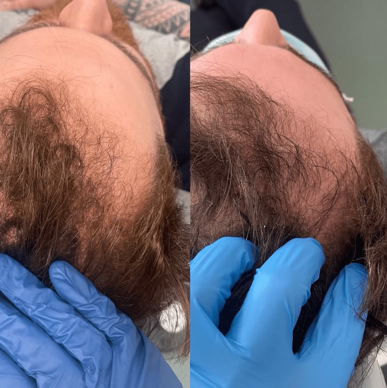PRP / PRF before and after — case 2, Dr Alexa Mayfair