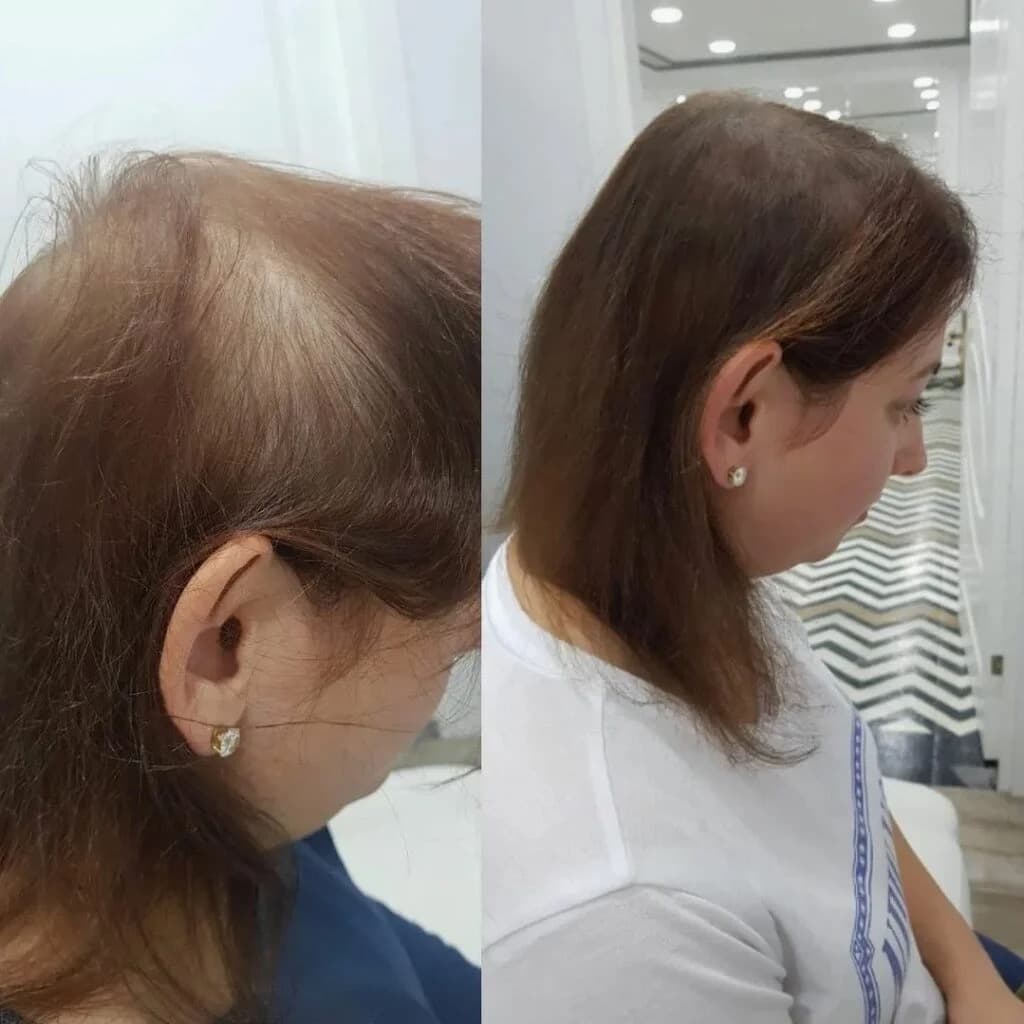 PRP / PRF before and after — case 3, Dr Alexa Mayfair