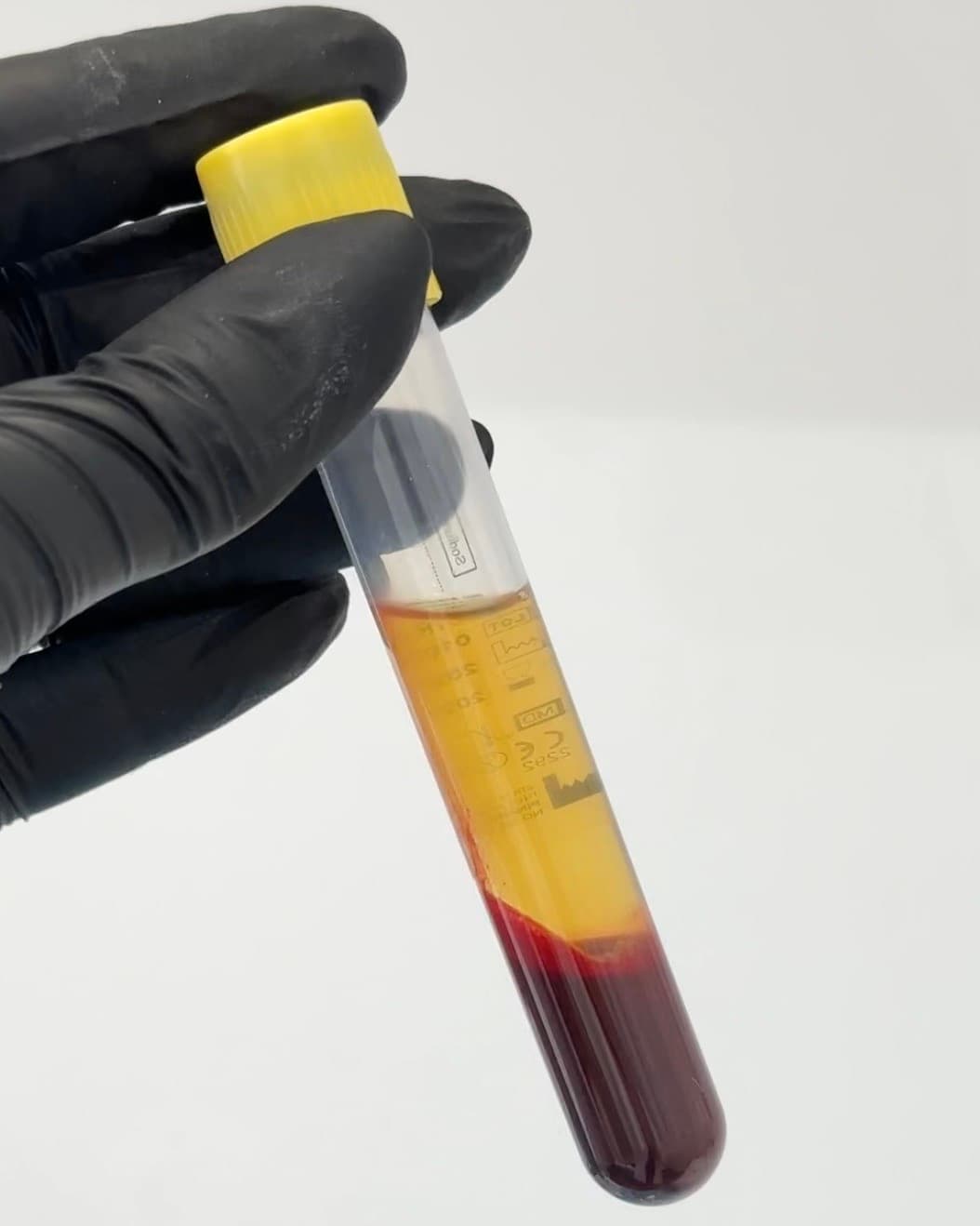 PRP / PRF treatment at Dr Alexa, Mayfair London