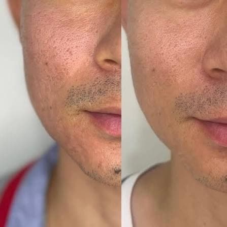 Rejuran before and after — case 1, Dr Alexa Mayfair