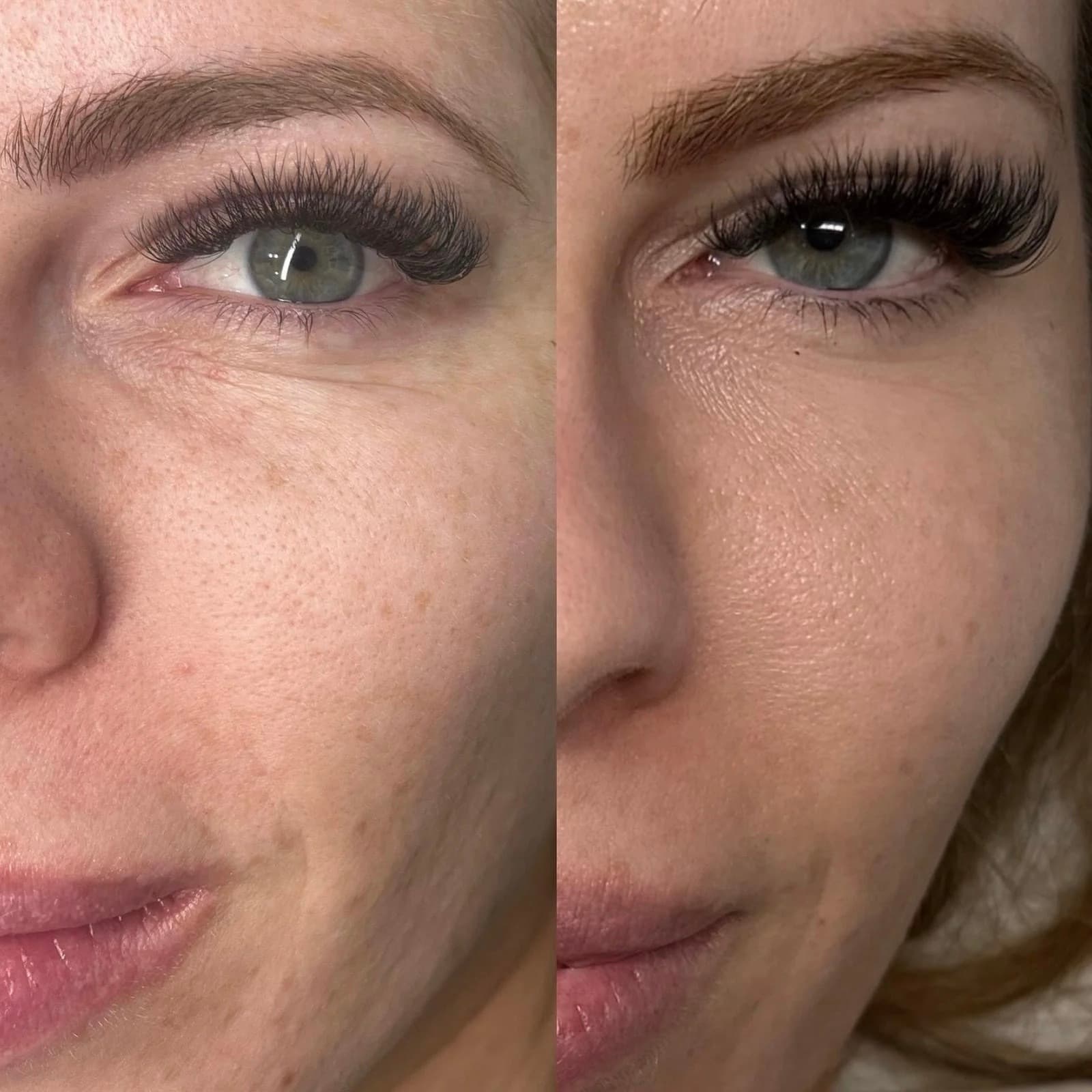 Rejuran before and after — case 2, Dr Alexa Mayfair