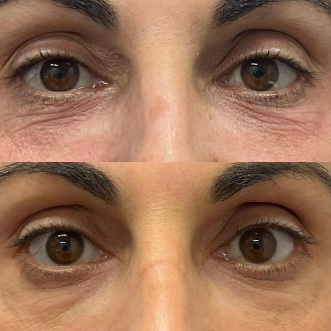Rejuran before and after — case 3, Dr Alexa Mayfair