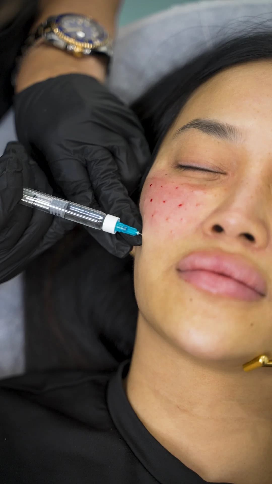 Rejuran treatment at Dr Alexa, Mayfair London