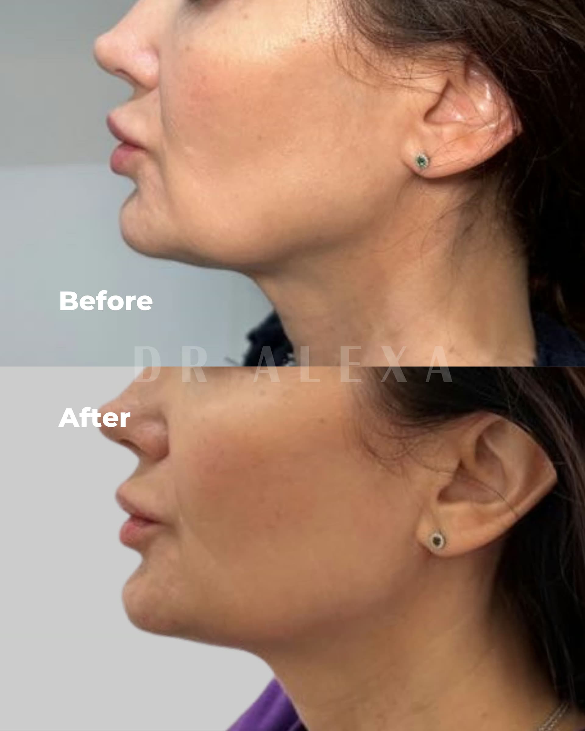 Sculptra before and after — case 2, Dr Alexa Mayfair