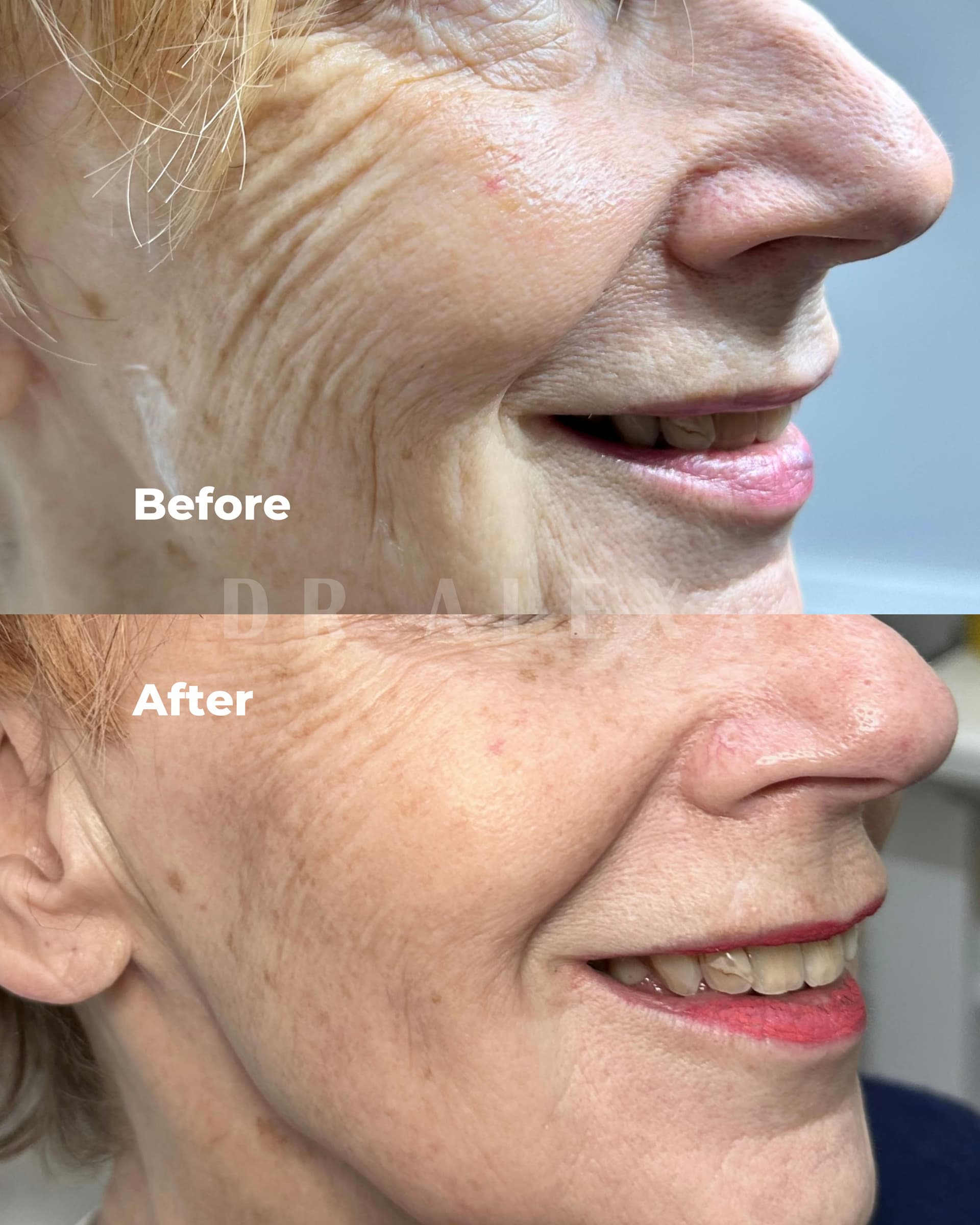 Skin Boosters before and after — case 1, Dr Alexa Mayfair