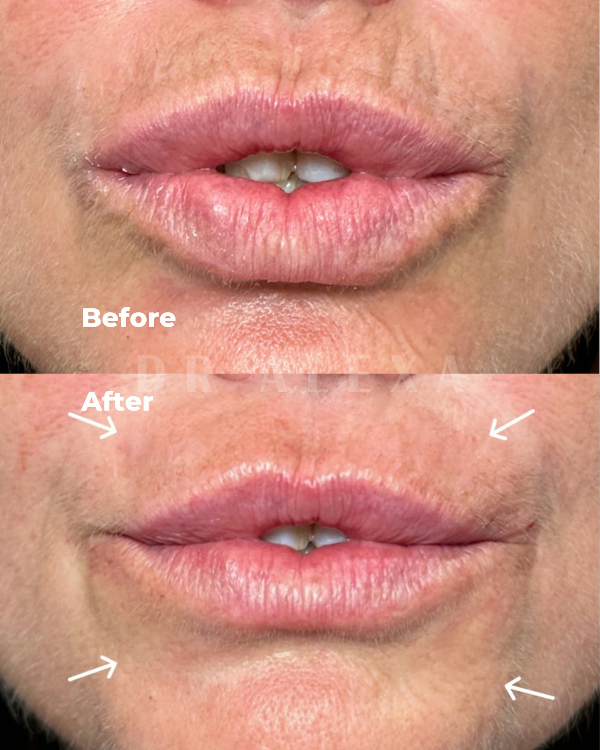 Skin Boosters before and after — case 2, Dr Alexa Mayfair