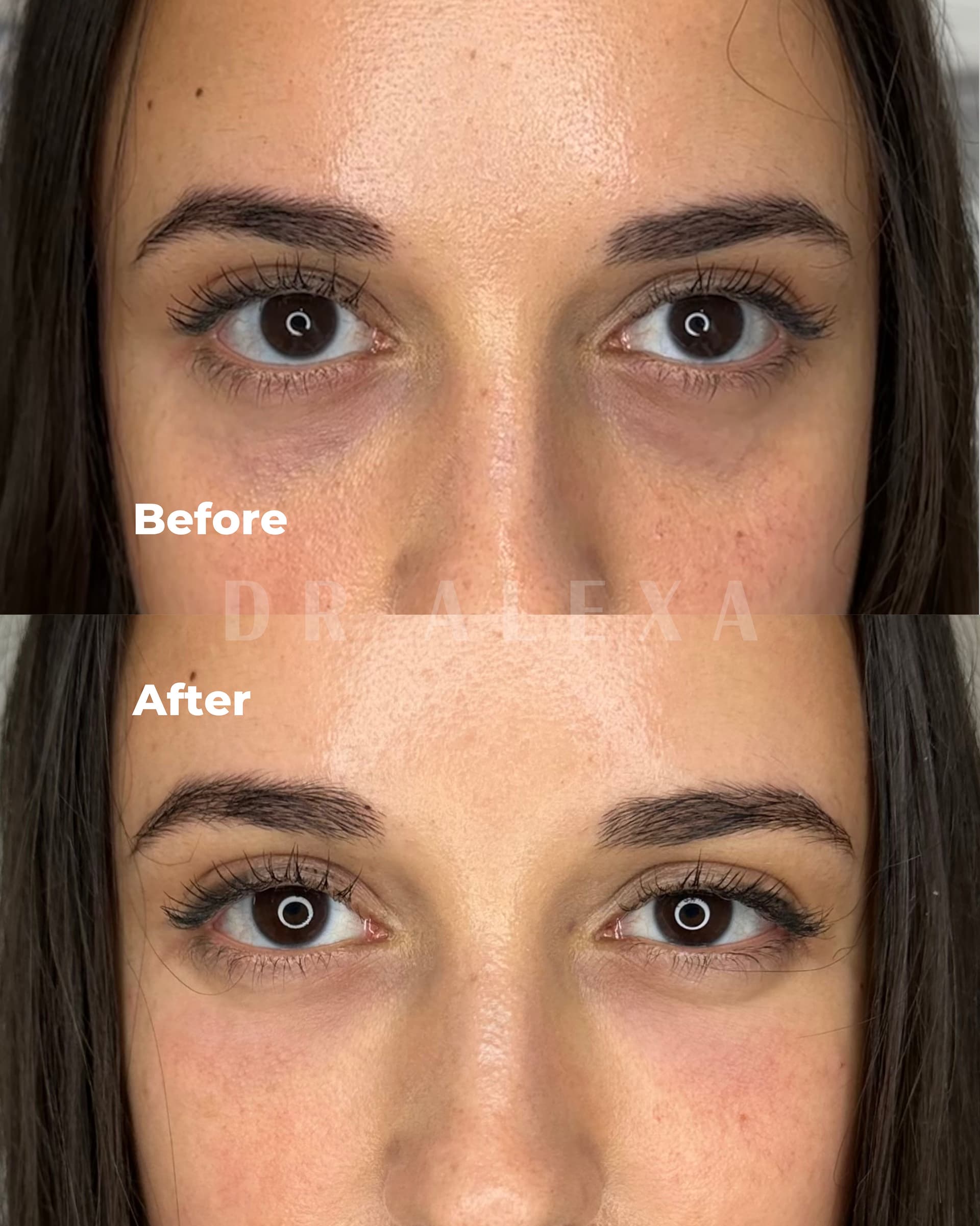 SuneKos before and after — case 1, Dr Alexa Mayfair