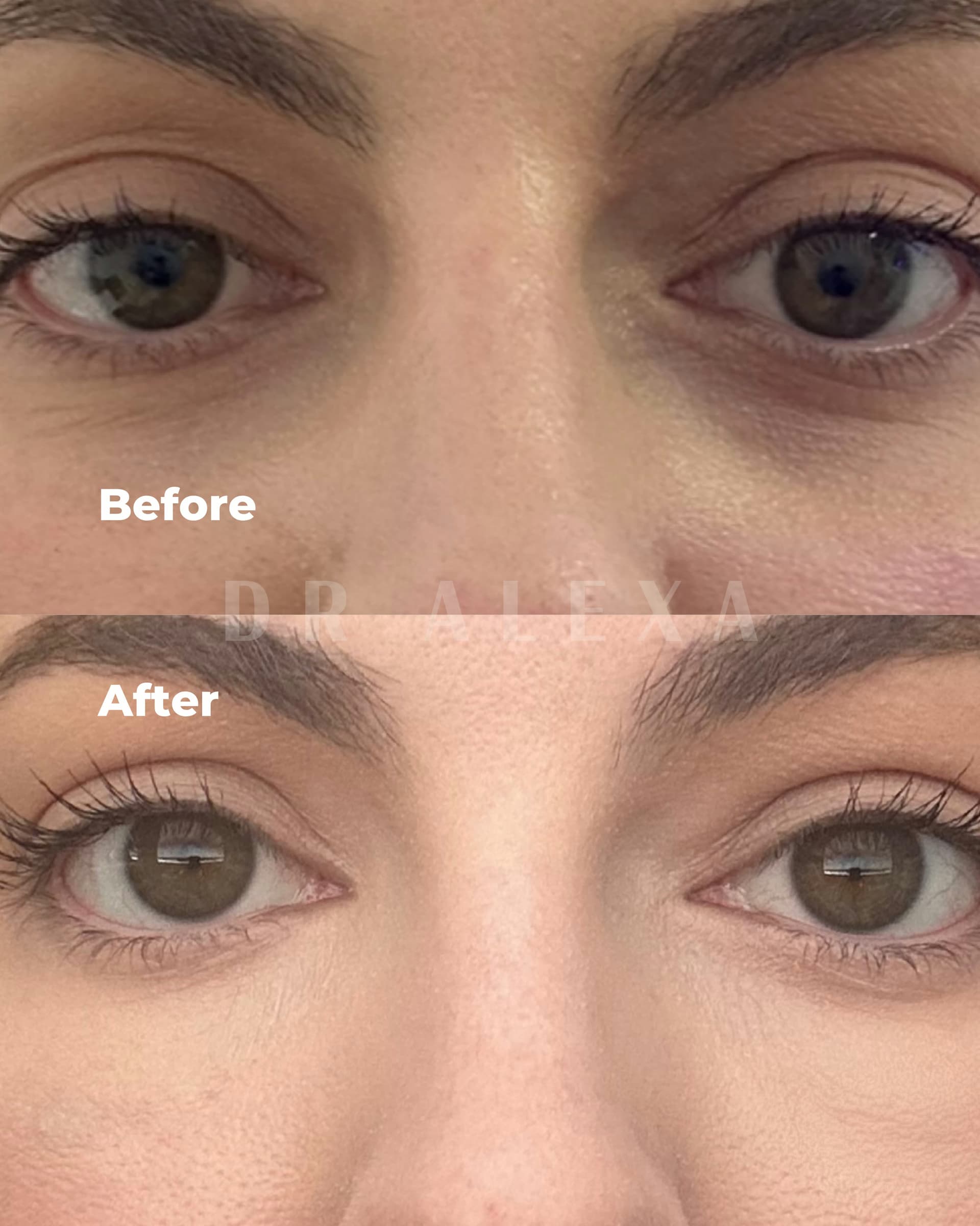 SuneKos before and after — case 2, Dr Alexa Mayfair