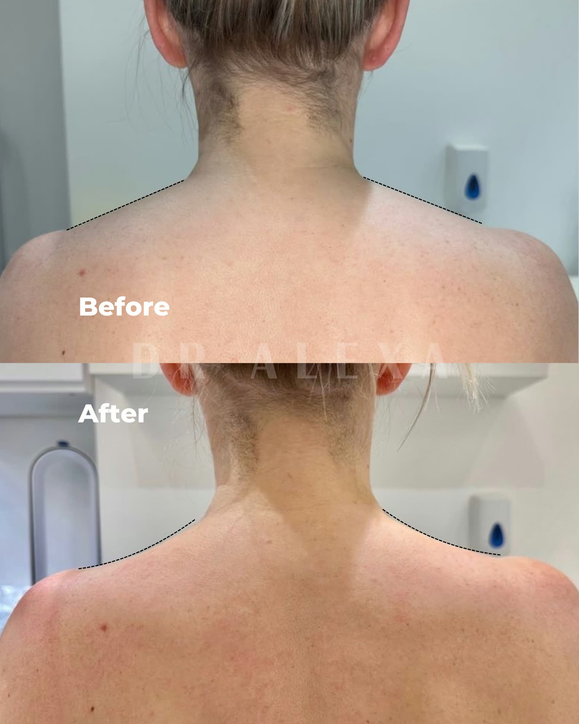 Trapezius Slimming before and after — case 1, Dr Alexa Mayfair