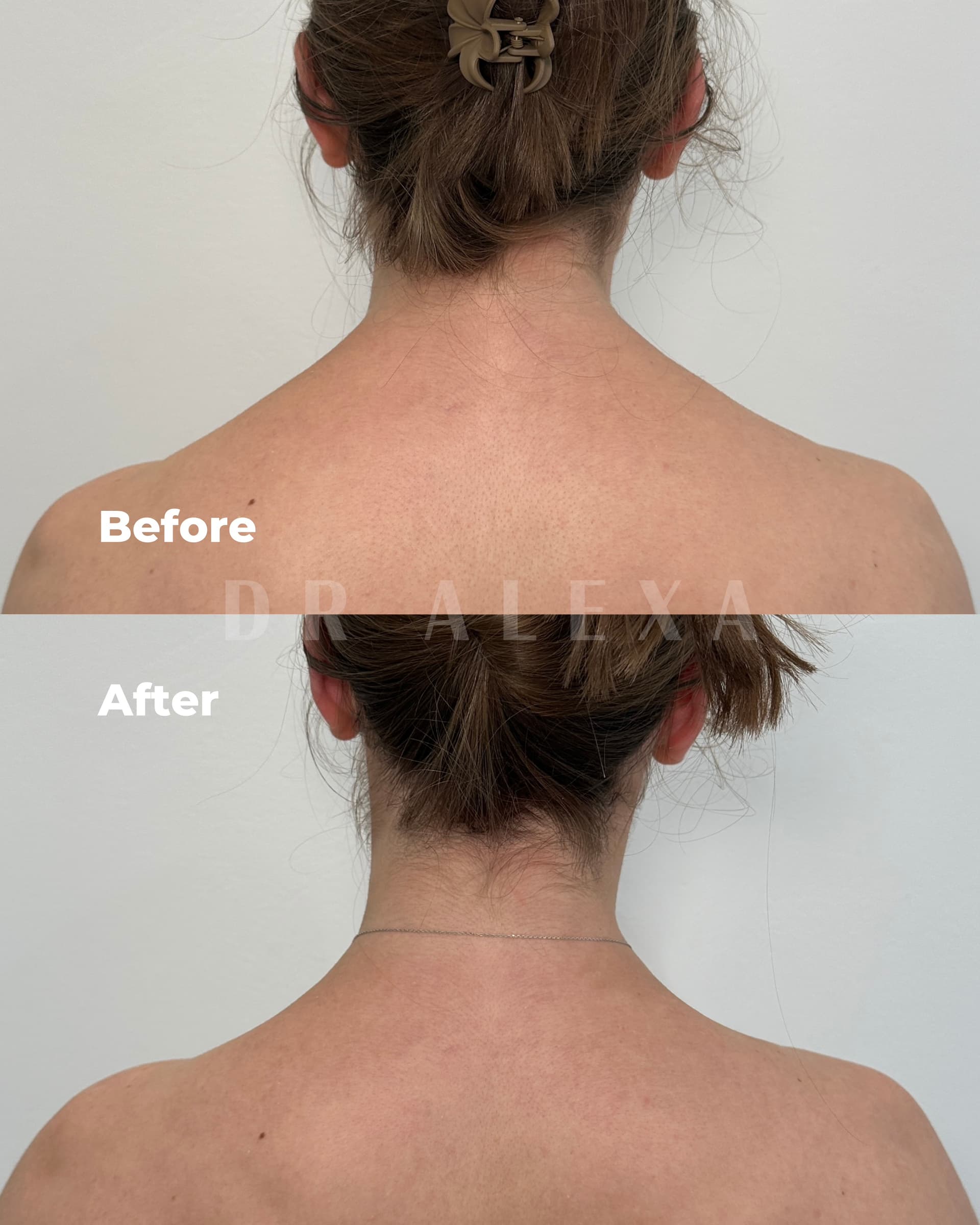 Trapezius Slimming before and after — case 2, Dr Alexa Mayfair