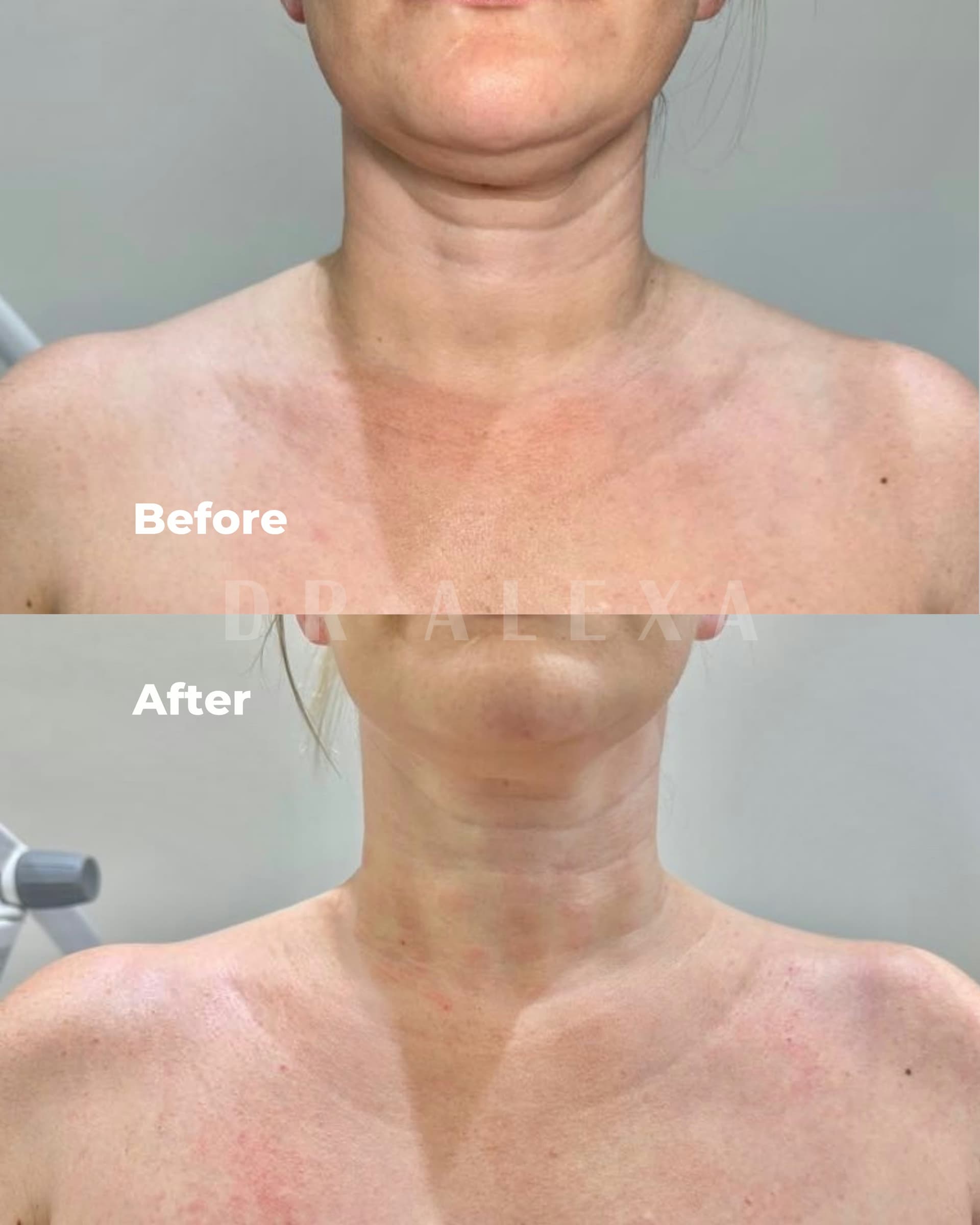 Trapezius Slimming before and after — case 3, Dr Alexa Mayfair