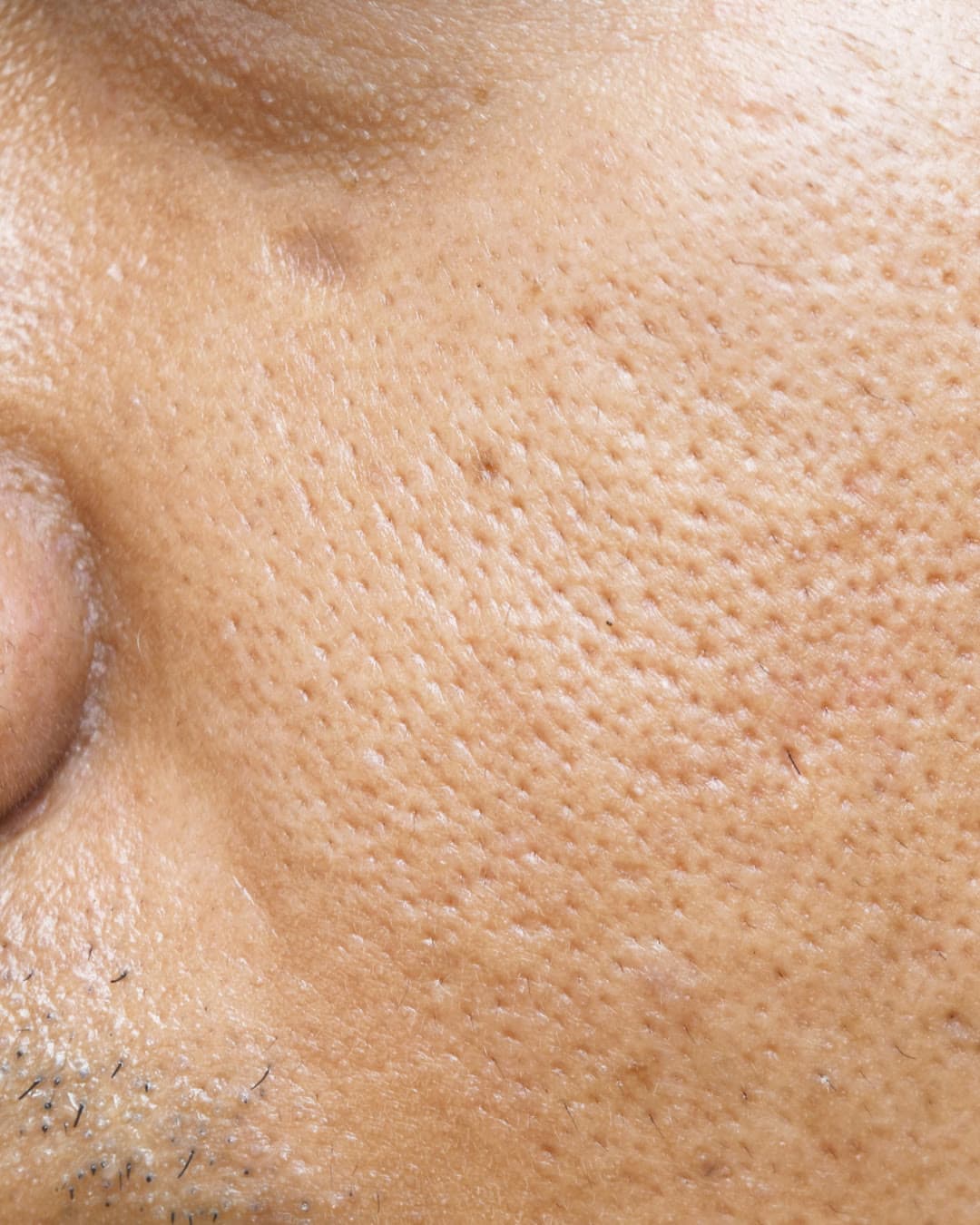 Enlarged Pores treatment at Dr Alexa, Mayfair London