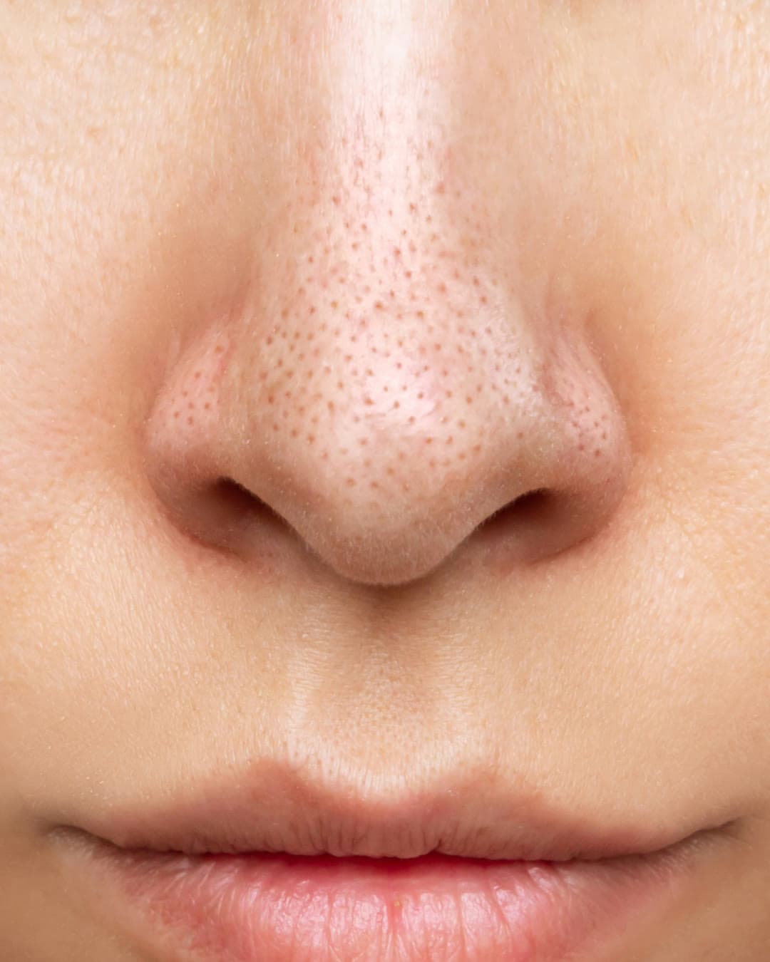 Enlarged Pores concern — Dr Alexa aesthetic clinic London