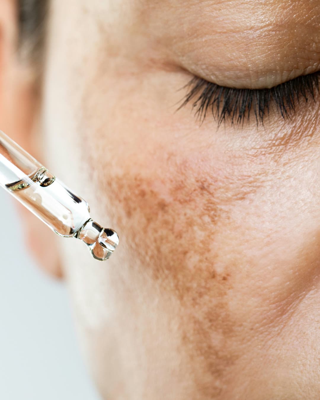 Hyperpigmentation treatment at Dr Alexa, Mayfair London