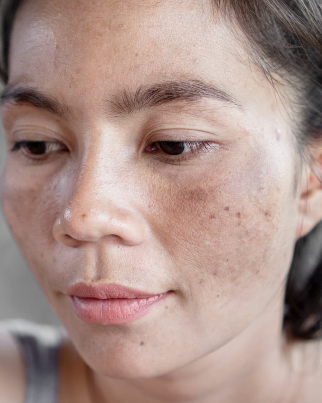 Hyperpigmentation concern — Dr Alexa aesthetic clinic London