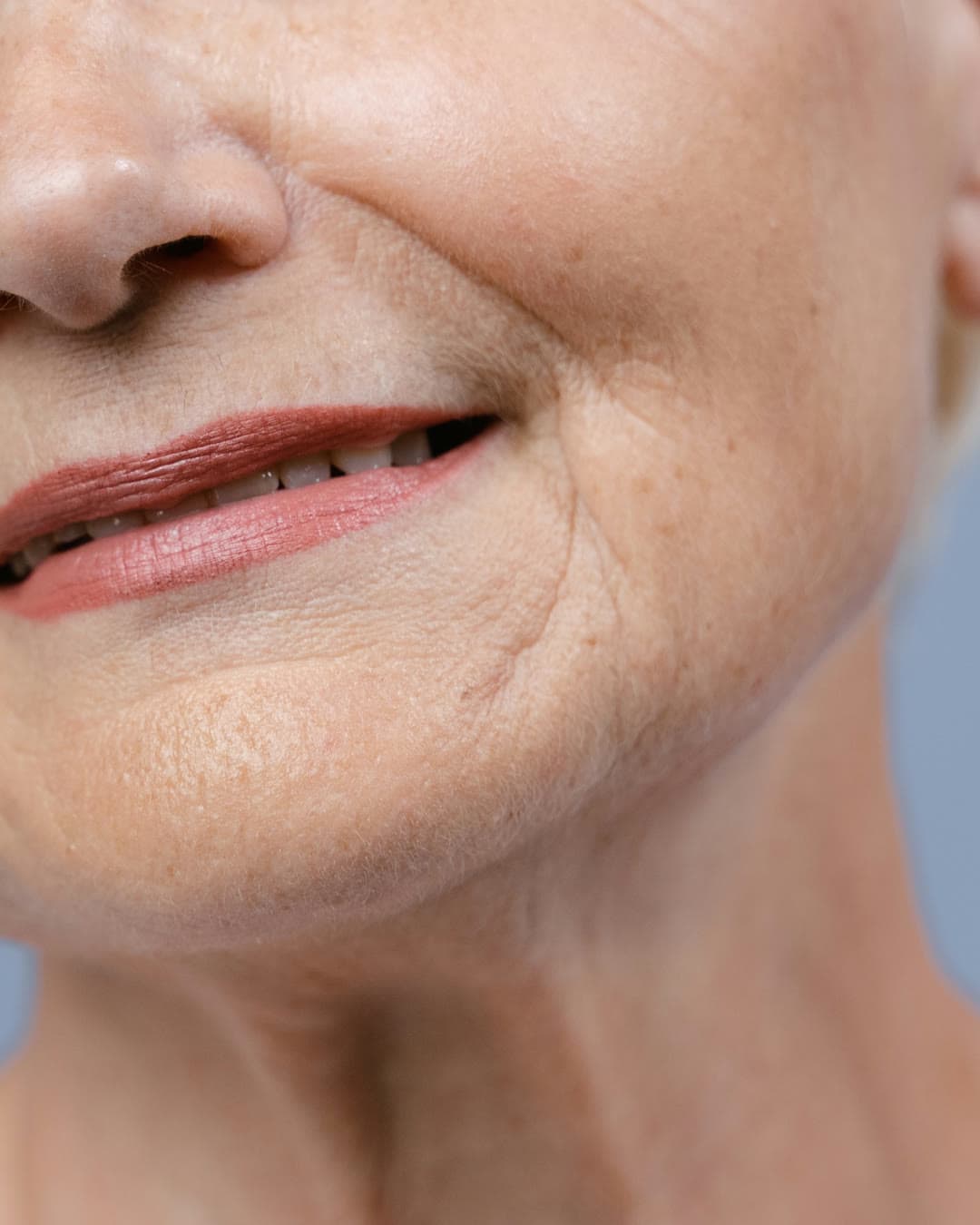 Lines and Wrinkles concern — Dr Alexa aesthetic clinic London