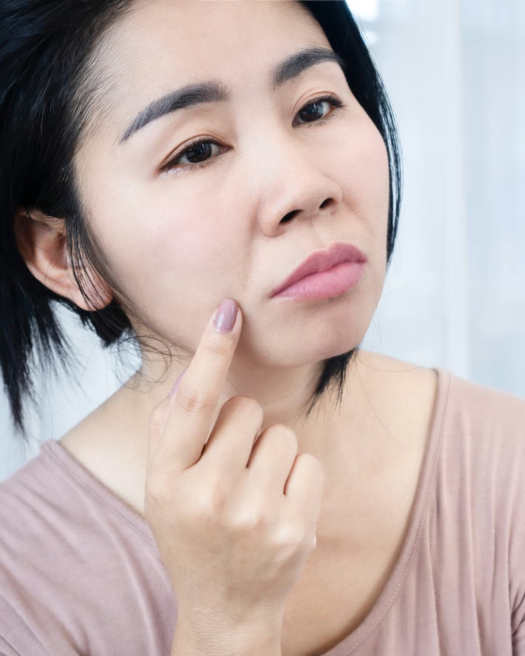 Nasolabial Folds / Marionette Lines treatment at Dr Alexa, Mayfair London