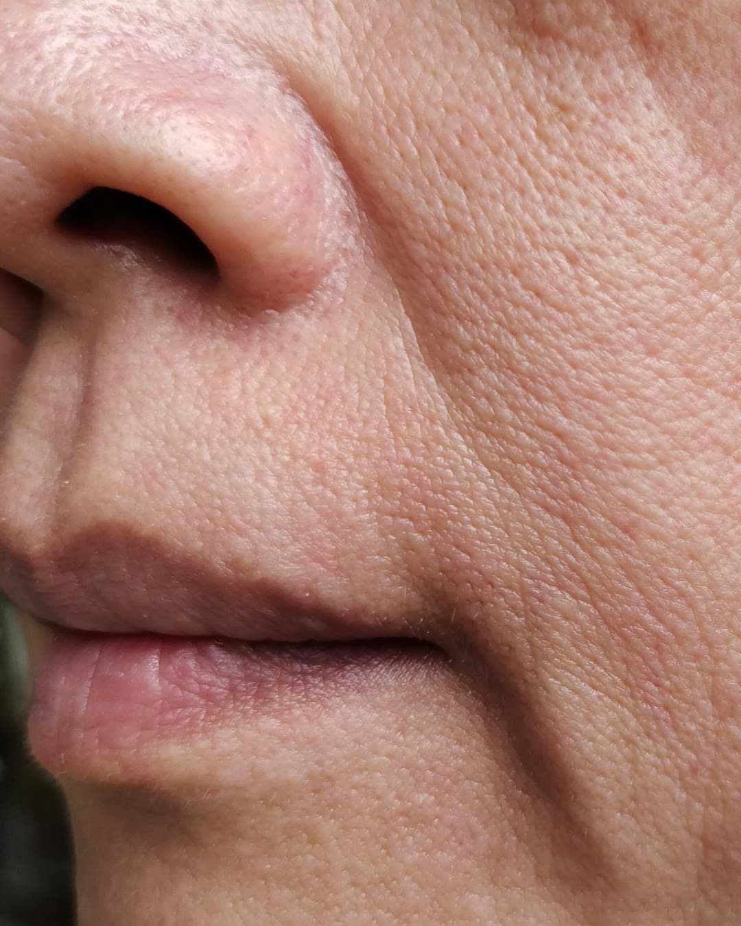 Nasolabial Folds / Marionette Lines concern — Dr Alexa aesthetic clinic London